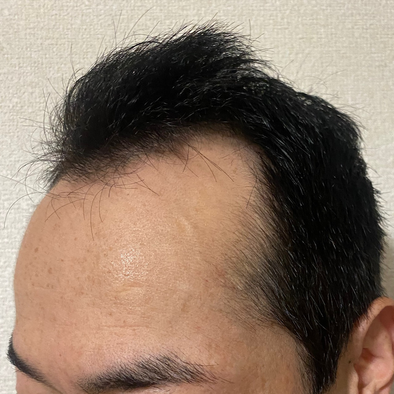 AGA治療11ヶ月13日経過〝左ソリ 濡れ髪〟写真