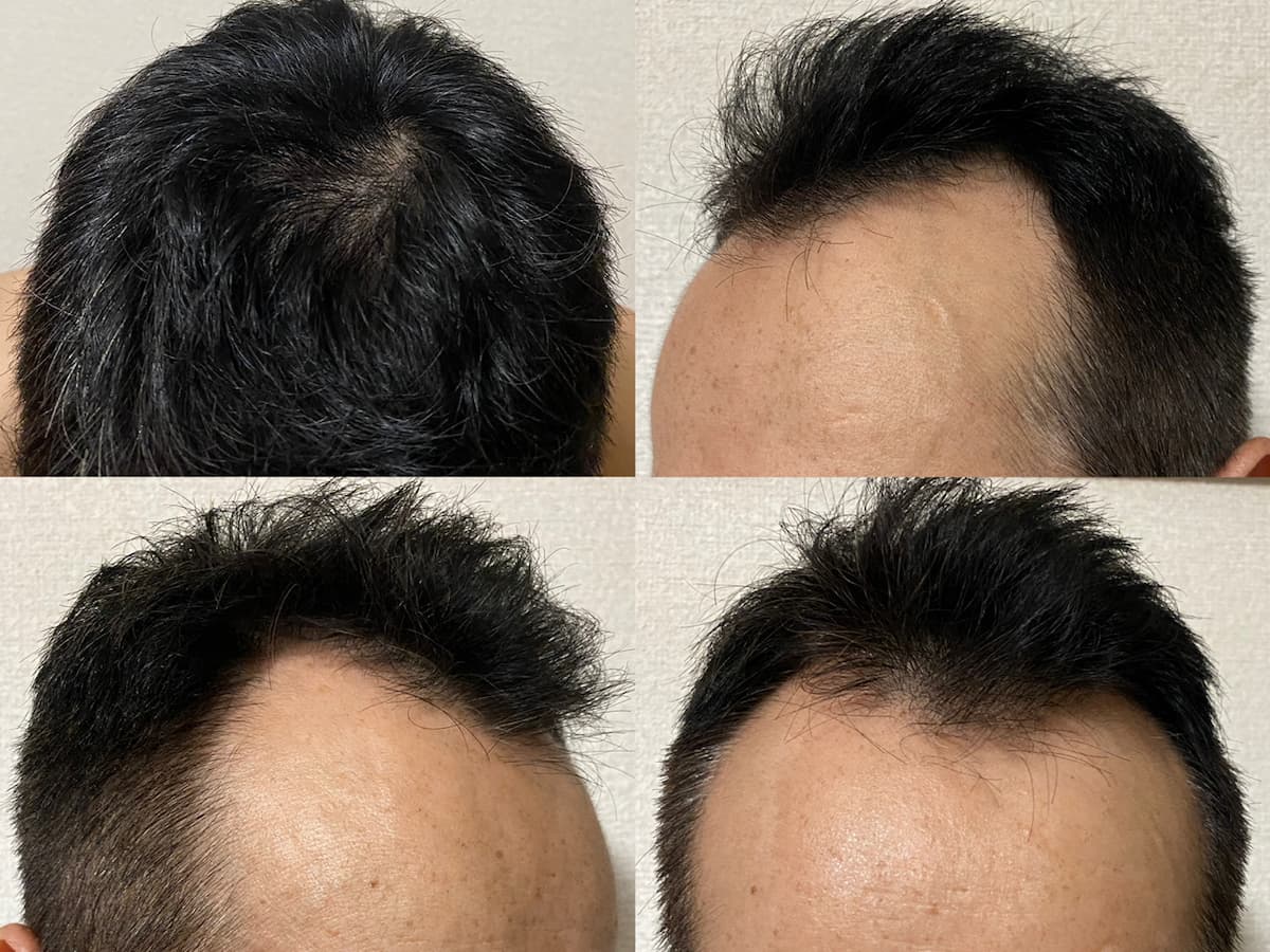 50代-確実に髪が増え回復した方法！？AGA治療丸11ヶ月経過報告！