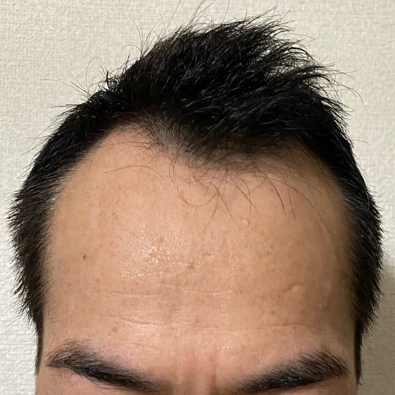 AGA治療12ヶ月10日経過〝M字生え際 濡れ髪〟写真
