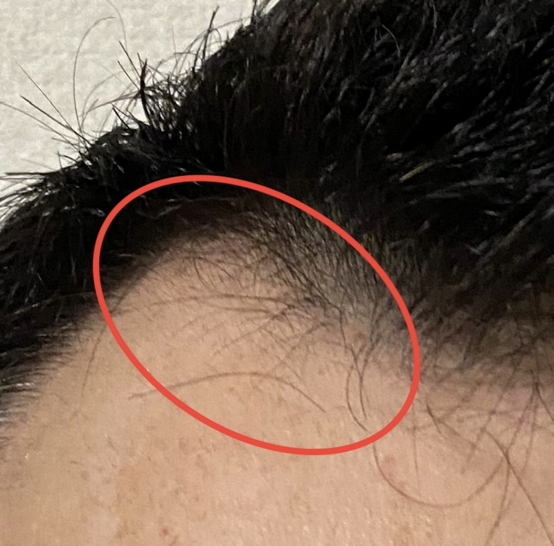 AGA治療12ヶ月9日経過〝M字生え際 濡れ髪〟拡大写真