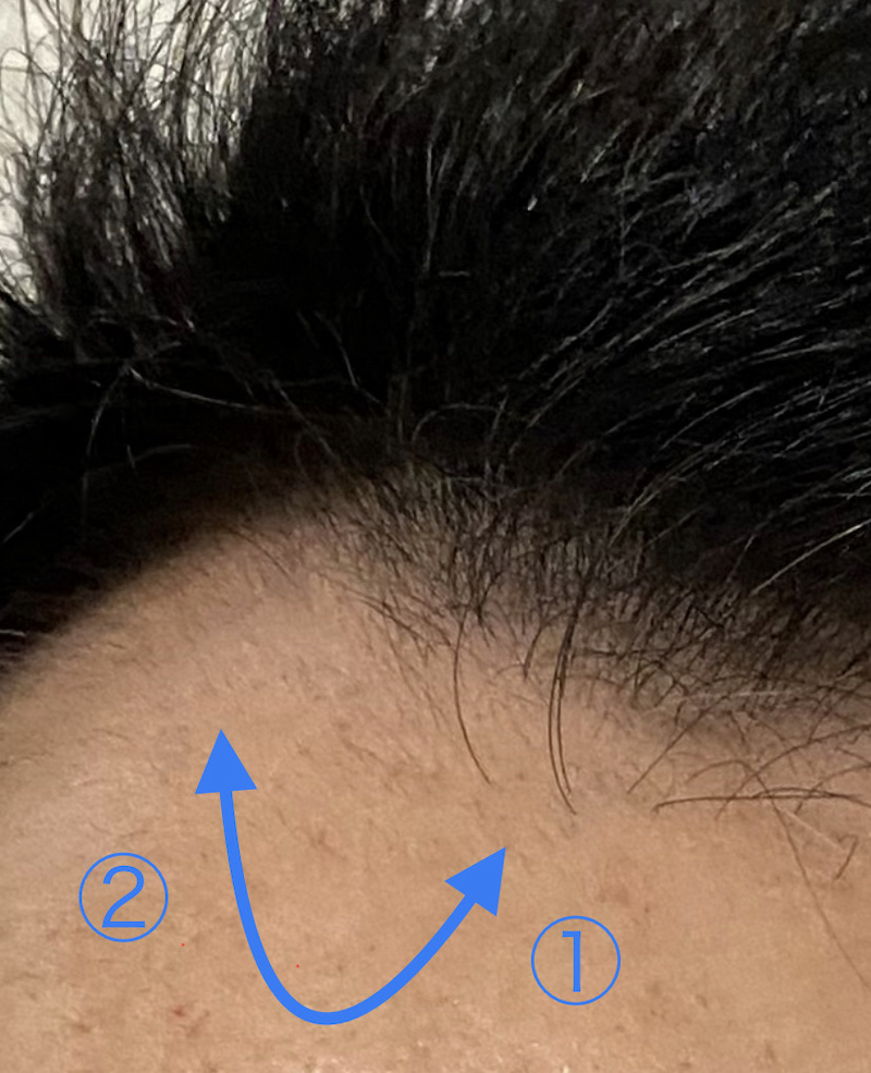 ミノタブ発毛効果が凄い〝M字生え際〟拡大画像