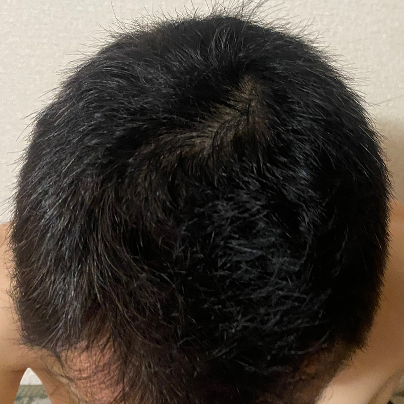 AGA治療〝頭頂部丸1年(12ヶ月)経過〟効果写真
