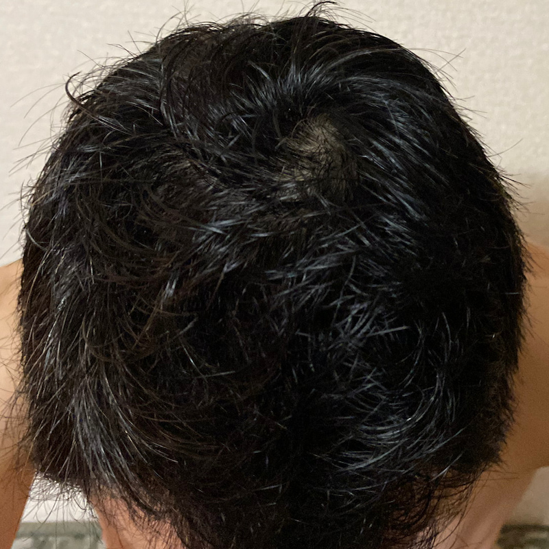 ミノキシジル13ヶ月22日経過〝濡れ髪 頭頂部〟写真