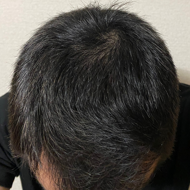 50代-AGA治療14ヶ月経過報告〝頭頂部〟写真