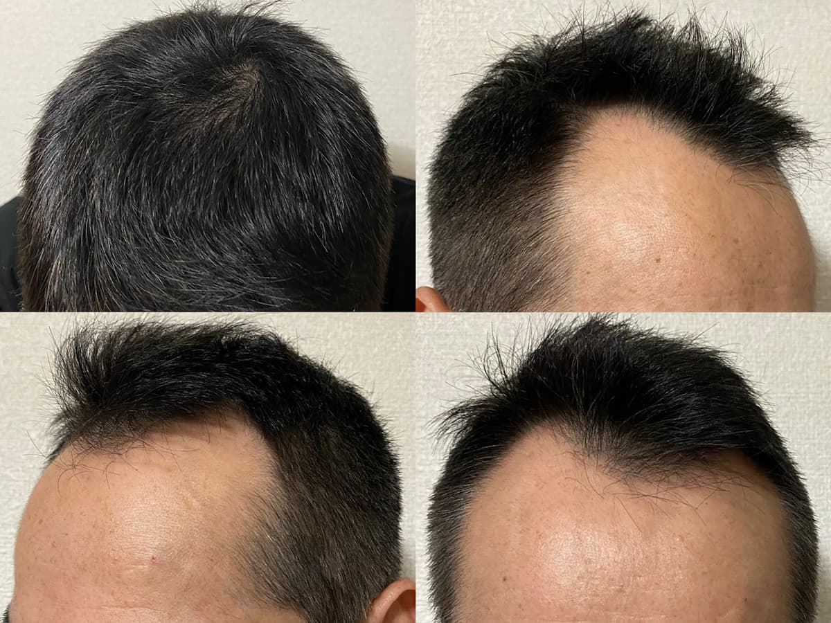 50代-AGA治療14ヶ月経過報告ブログ！？発毛効果や副作用状況です！