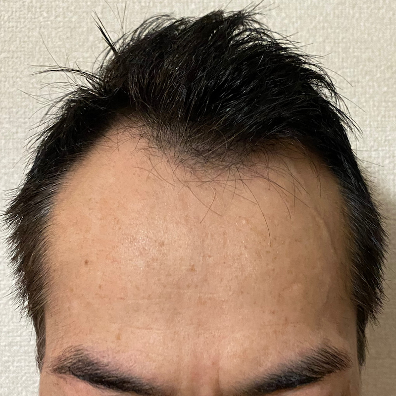 ミノキシジル13ヶ月22日経過〝濡れ髪 M字中央〟写真