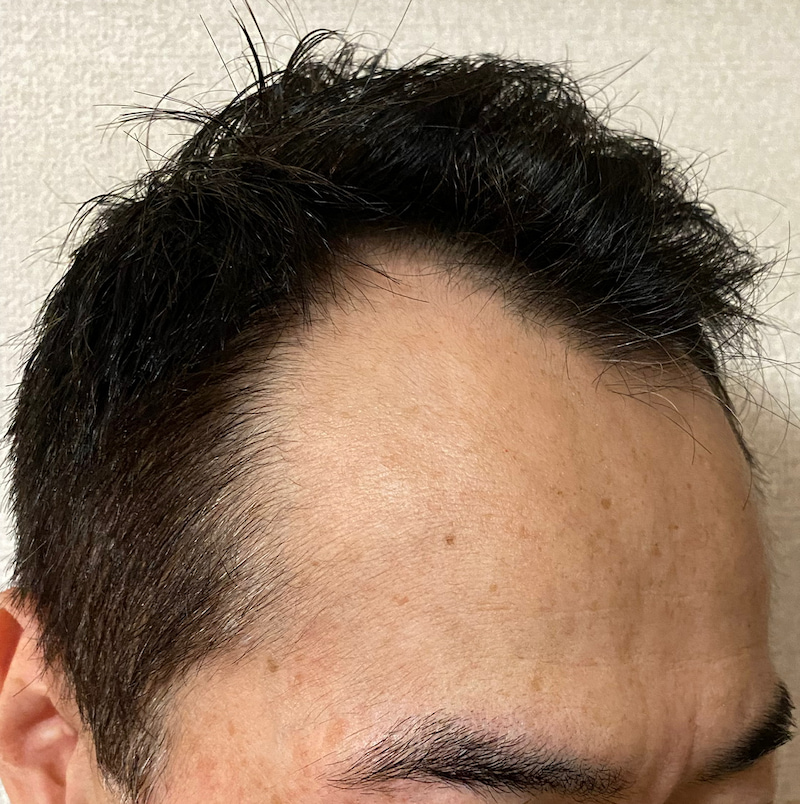 ミノキシジル13ヶ月22日経過〝濡れ髪 右ソリ〟写真