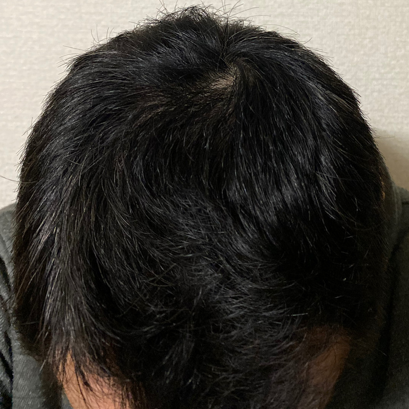 AGA治療14ヶ月18日経過〝頭頂部〟写真
