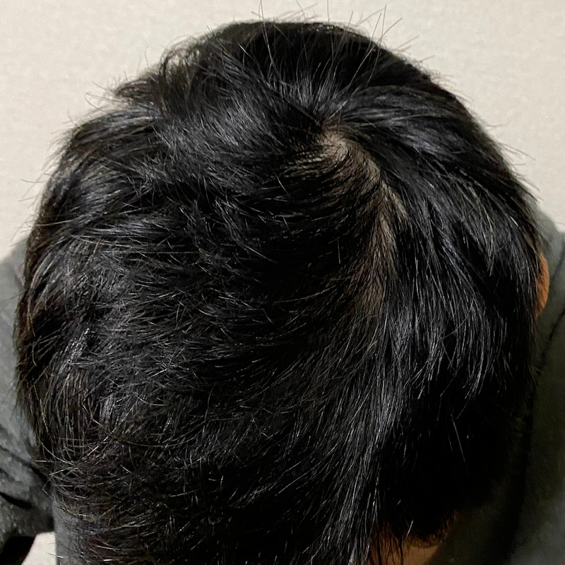 AGA治療16ヶ月経過〝頭頂部〟写真