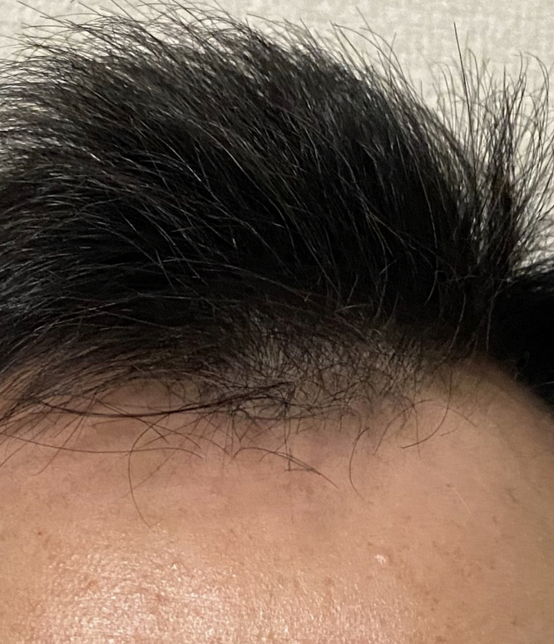 AGA治療15ヶ月23日経過〝前髪チェック〟拡大写真