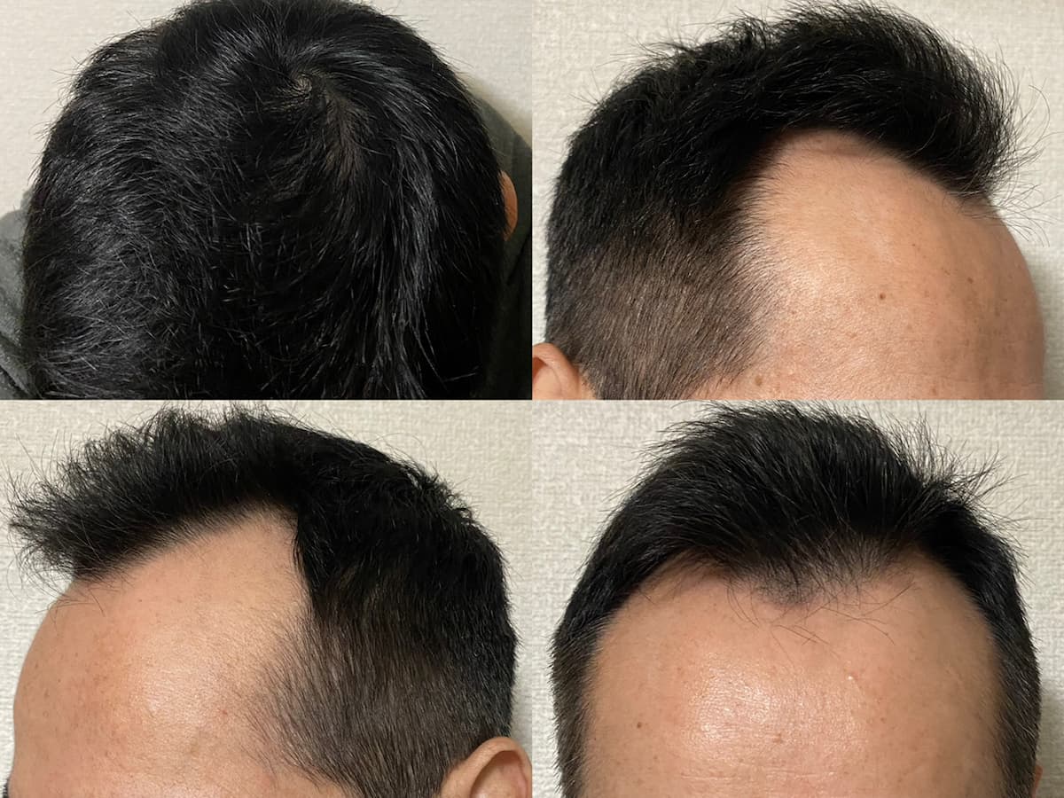 ミノタブ＆フィンペシア-髪太くなり髪質改善！AGA治療15ヶ月経過報告！