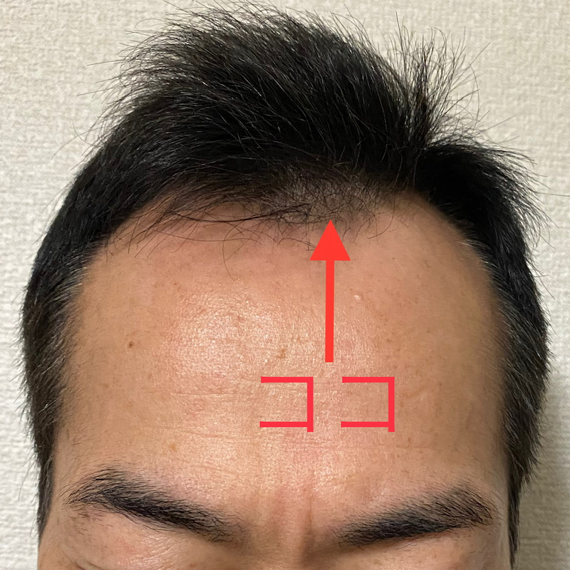 AGA治療15ヶ月23日経過〝前髪チェック〟写真