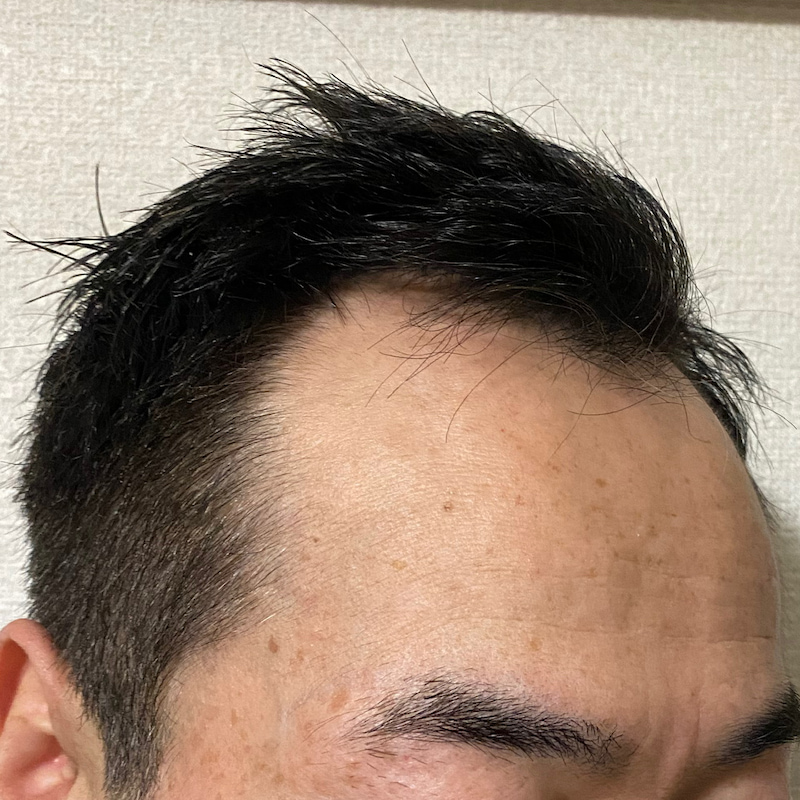 AGA治療16ヶ月7日経過〝M字生え際-右ソリ〟濡れ髪写真