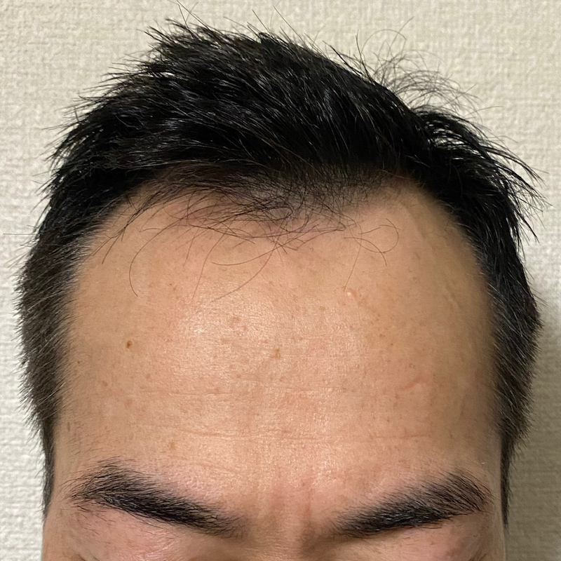 AGA治療16ヶ月7日経過〝M字生え際-中央〟濡れ髪写真