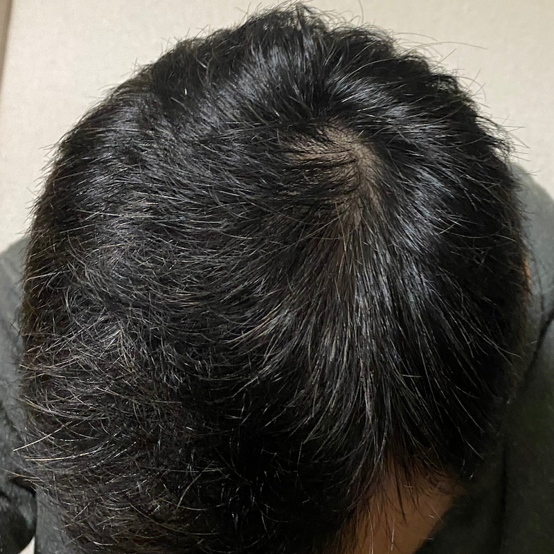 AGA治療17ヶ月経過報告〝頭頂部〟写真