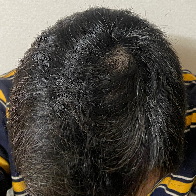 AGA治療19ヶ月経過〝頭頂部〟写真
