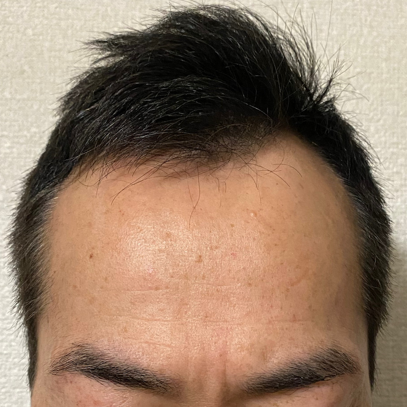 前髪-ミノキシジルとフィナステリド18ヶ月効果写真