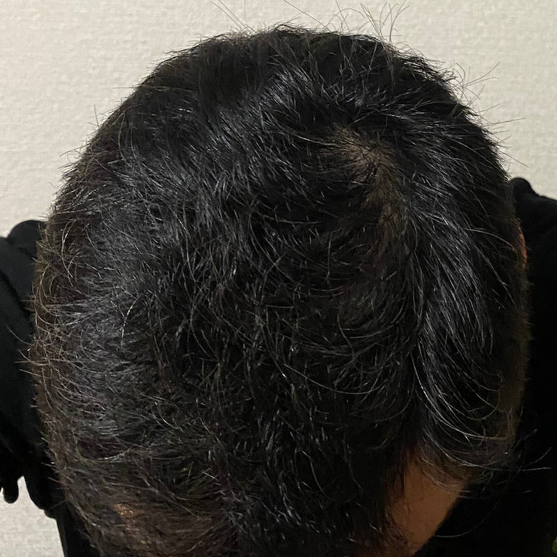 AGA治療20ヶ月経過〝頭頂部〟写真