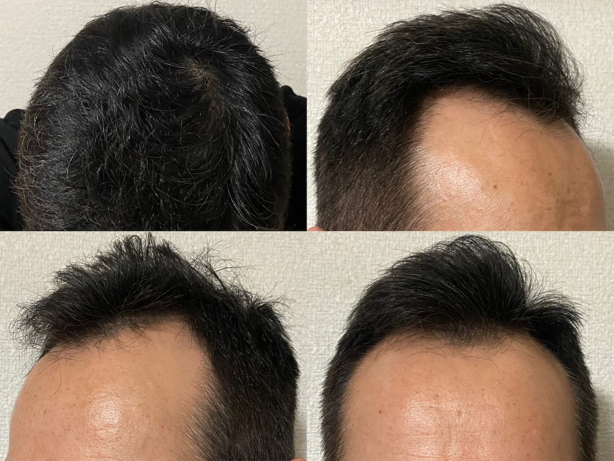 50代-AGA治療20ヶ月効果報告！髪のハリコシUP、濡れてもスカスカしない！