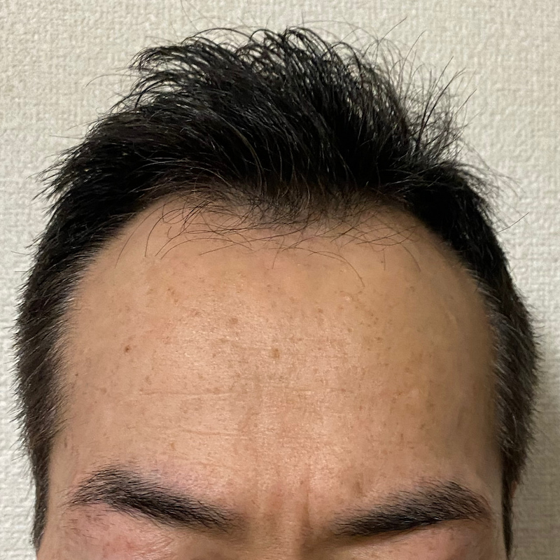 AGA治療20ヶ月経過〝濡れ髪〟写真