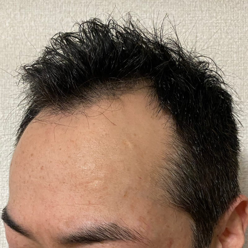 AGA治療20ヶ月経過〝濡れ髪②〟写真