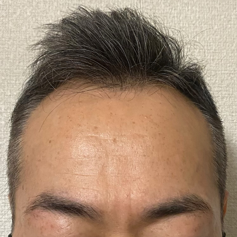AGA治療2年6ヶ月〝M字生え際-中央〟写真