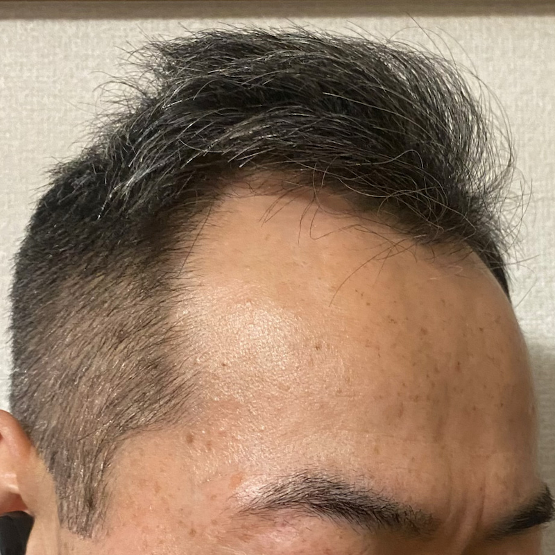 AGA治療2年6ヶ月〝M字生え際-右ソリ〟写真