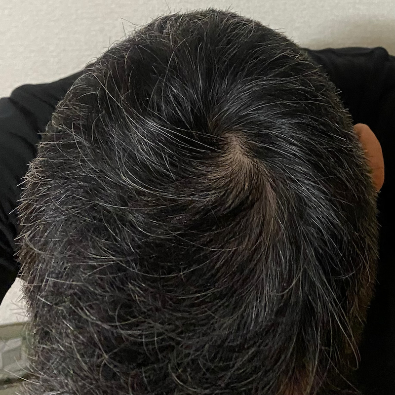 AGA治療2年6ヶ月〝頭頂部〟写真