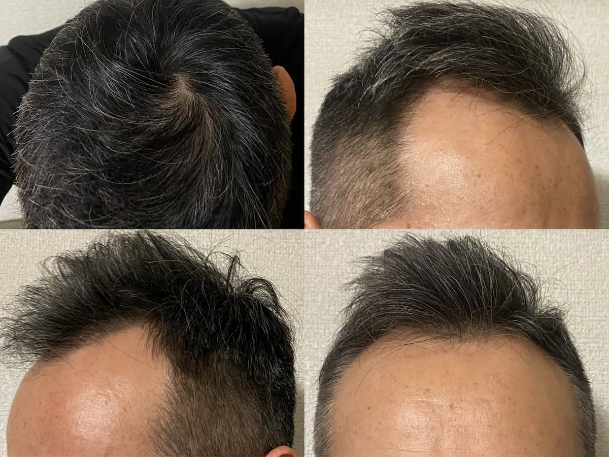 50代-AGA治療2年6ヶ月経過報告-写真
