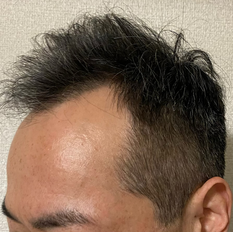AGA治療2年6ヶ月〝M字生え際-左ソリ〟写真