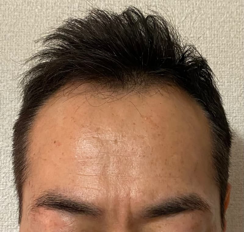刈り上げ下手過ぎて自分でカット後-写真