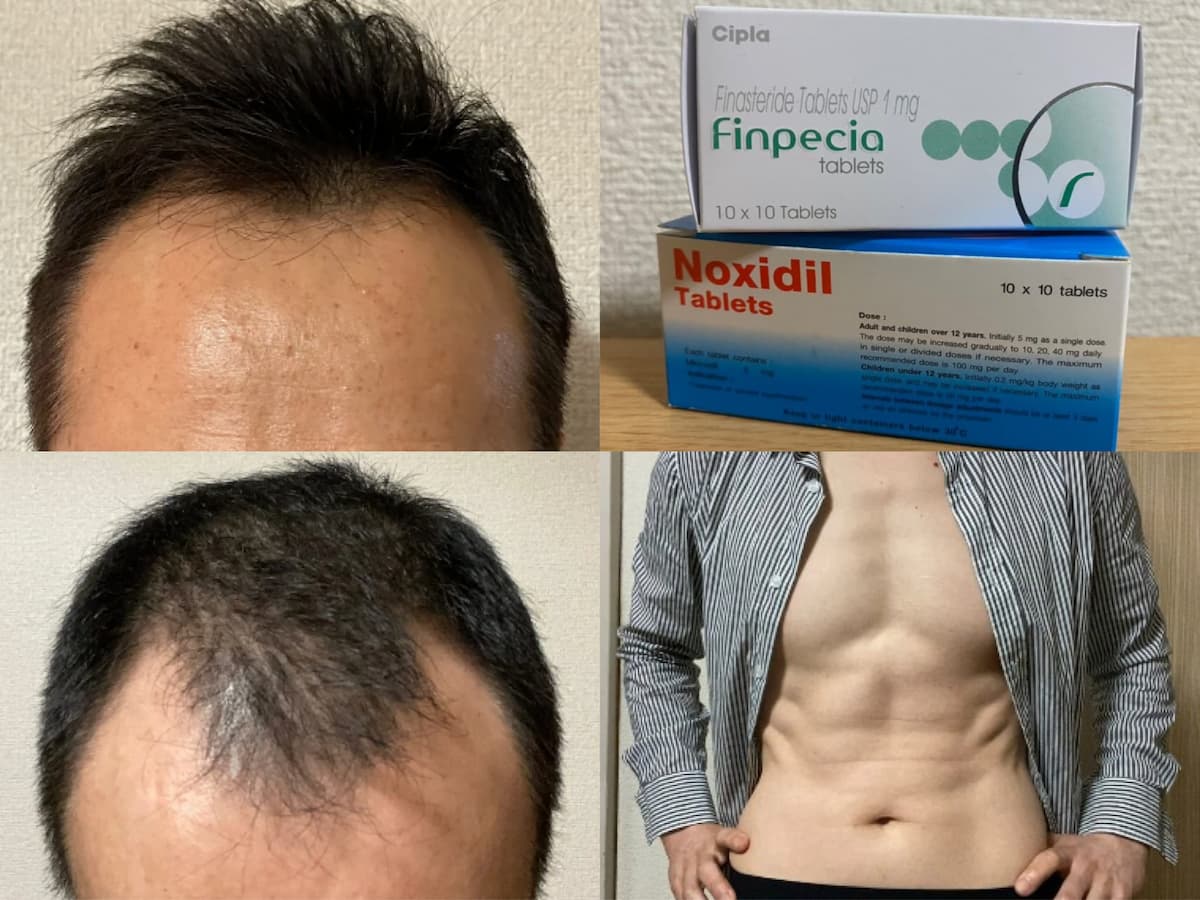 50代AGA治療中-若返り×佐藤式リンパ(薄毛・白髪ケア)で髪増えそう！