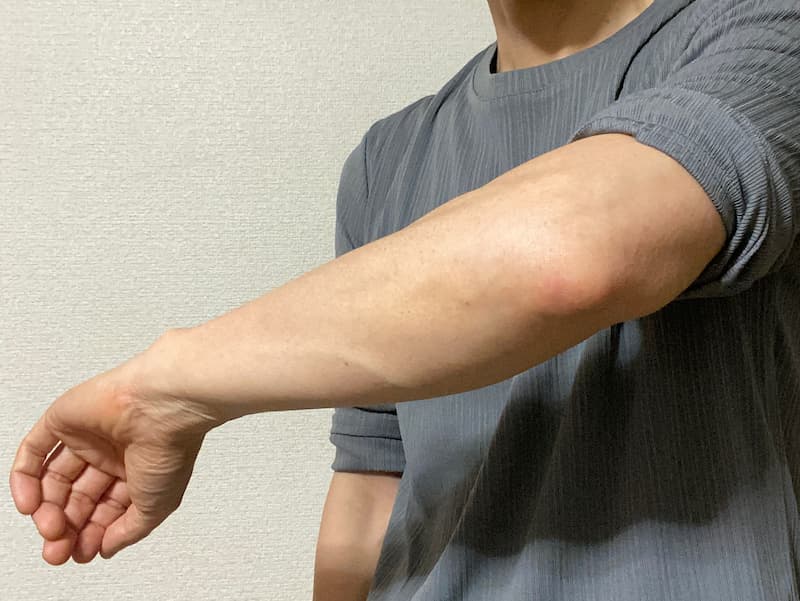 肘回りがツルツル肌に変化-写真