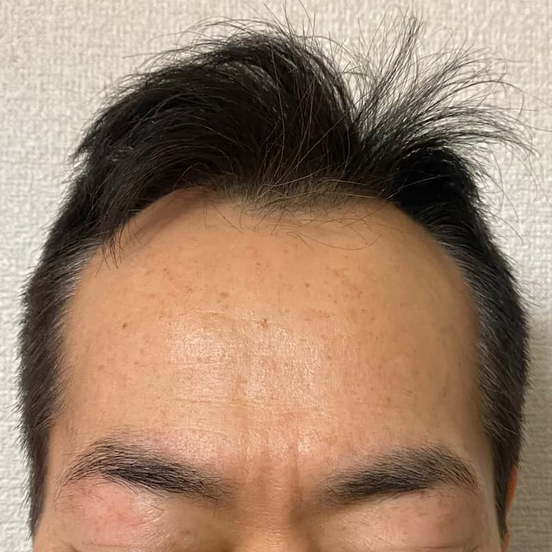 AGA治療薬3年以上継続-M字生え際写真