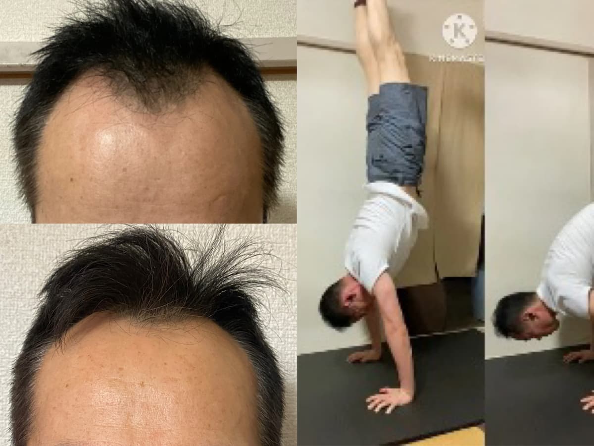 【不老不死】AGA治療薬3年以上経過！54才男、今後も継続方針です！