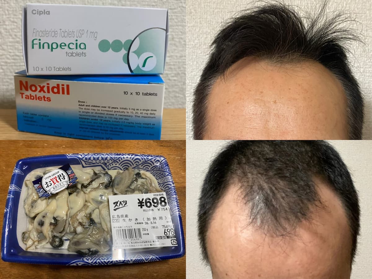 50代-AGA治療薬＋佐藤式リンパケアで増毛目指す！牡蠣の常食も開始〜