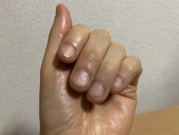 爪の状態-写真1