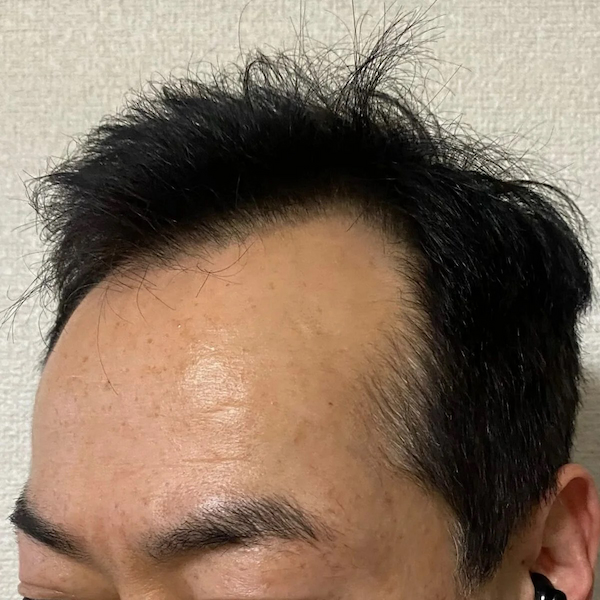 佐藤式リンパケアで黒髪生えてきた-写真1