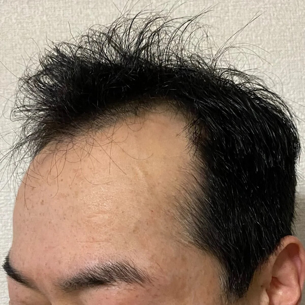 佐藤式リンパケアで黒髪生えてきた-写真3